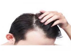 زراعة الشعر