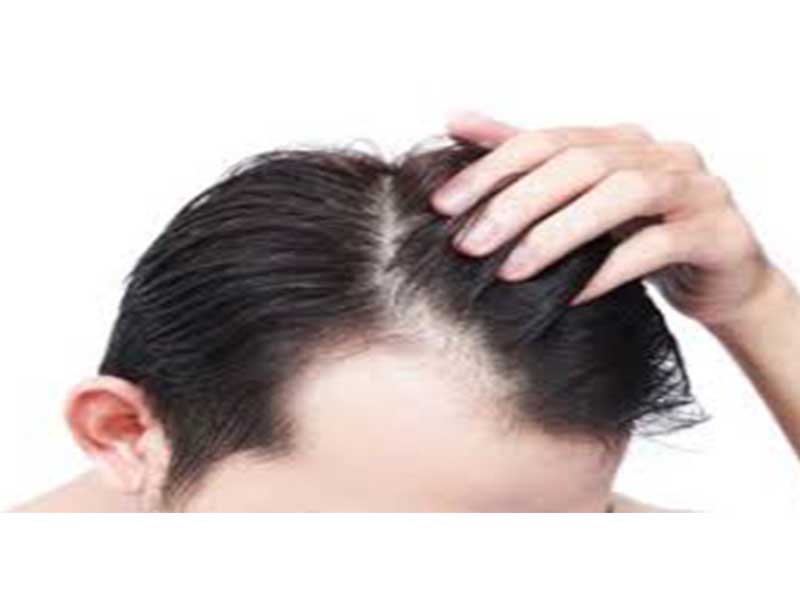 زراعة الشعر